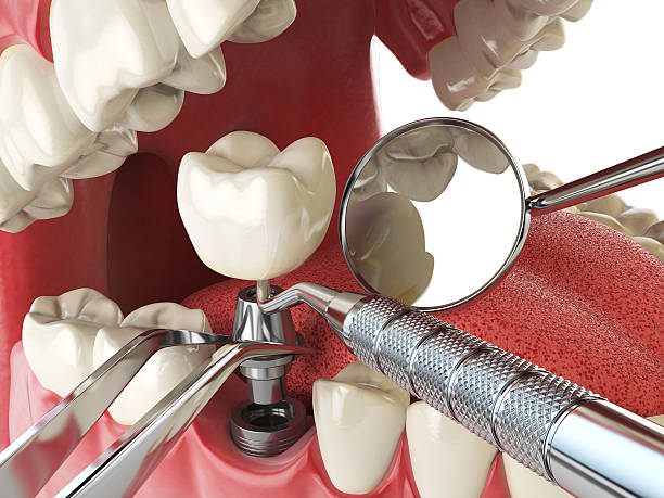 Best Dentist for Tooth Abscess  in Lincoln, MT